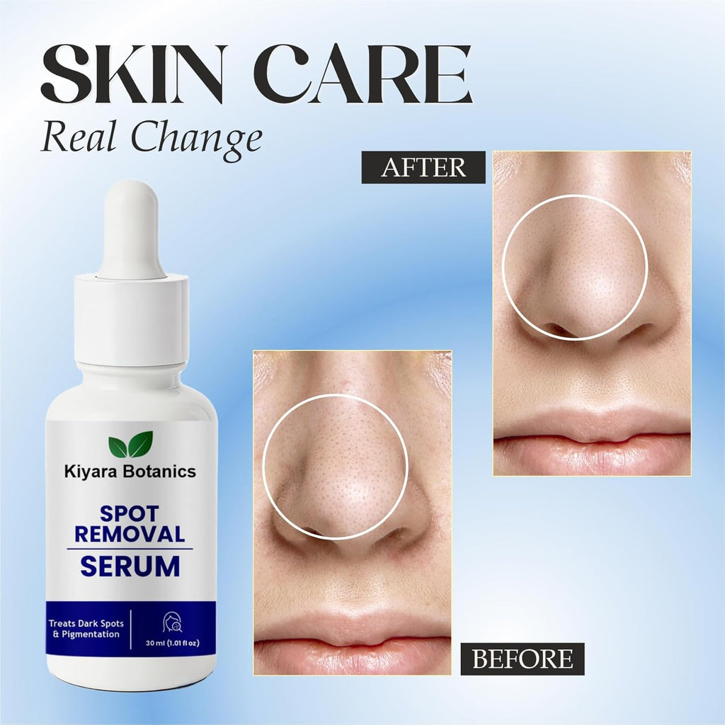 Kiyara Botanics Spot Removal Serum for Dark Spots and Pigmentation Treatment, Natural Botanical Formula, 30ml (1.01 fl oz)