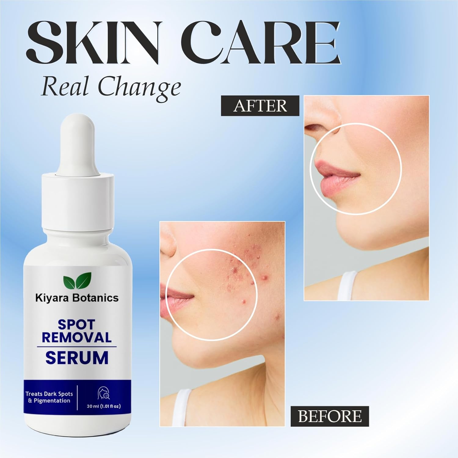Kiyara Botanics Spot Removal Serum for Dark Spots and Pigmentation Treatment, Natural Botanical Formula, 30ml (1.01 fl oz)